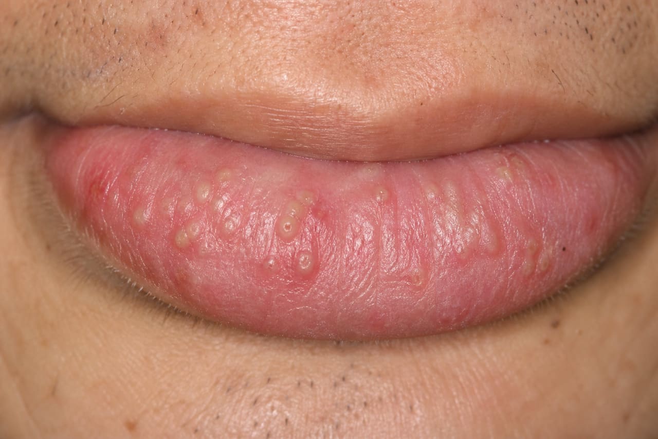 Close-Up of Lower Lip Showing Cheilitis Glandularis Symptoms