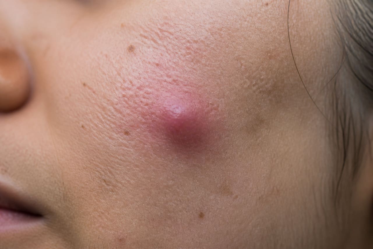 Inflamed Cystic Acne Bump on Human Cheek