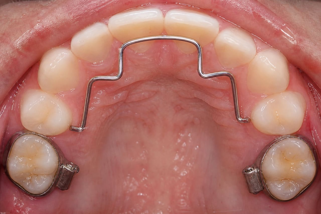 Ricketts Utility Arch Installed on Upper Dental Arch